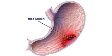 Mide Kanseri Belirtileri ve Tedavisi