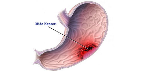 Mide Kanseri